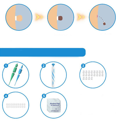 Handheld Skin-Tag Removal Tool Kit